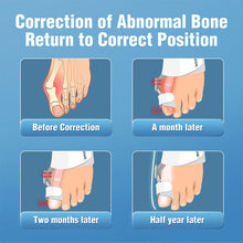 Load image into Gallery viewer, Upgraded Bunion Corrector - 3D Knob Toe Corrector