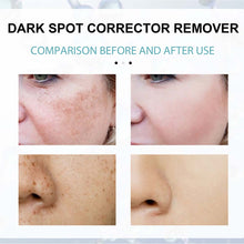 Load image into Gallery viewer, Anti-Dark Spot Skin Care Lightens Pigmentation Spots
