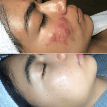Load image into Gallery viewer, HexoWand™ High Frequency Skin Therapy