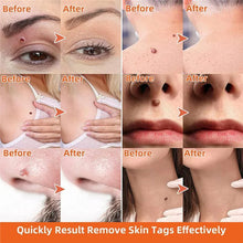 Load image into Gallery viewer, Auto Skin Tag Remover Painless