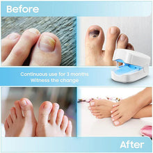 Load image into Gallery viewer, Nail Fungus Cleaning Laser Device - Expert Revolutionary High-Efficiency Light Therapy Device For Toenail Diseases