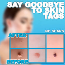 Load image into Gallery viewer, Painless Skin Tag Remover
