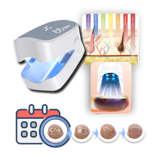 Load image into Gallery viewer, Laser Therapy, Pain-Free For Nail Fungus
