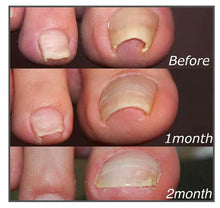 Load image into Gallery viewer, Easy Patches - Correction Patches For Beautiful And Healthy Nails
