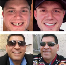 Load image into Gallery viewer, Adjustable Snap-On Dentures
