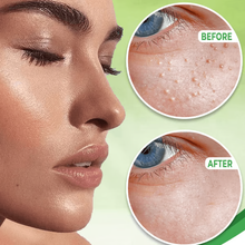 Load image into Gallery viewer, Eye Milia Removal Cream
