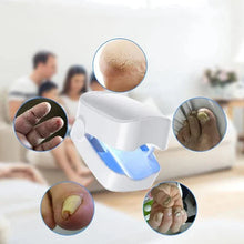 Load image into Gallery viewer, Nail Fungus Cleaning Laser Device - Expert Revolutionary High-Efficiency Light Therapy Device For Toenail Diseases
