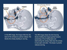 Load image into Gallery viewer, Apnea Tongue Stabilizing Device
